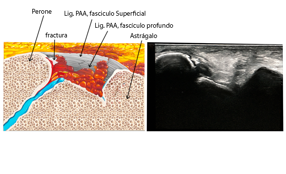 Rotura del ligamento peroneo astragalino anterior