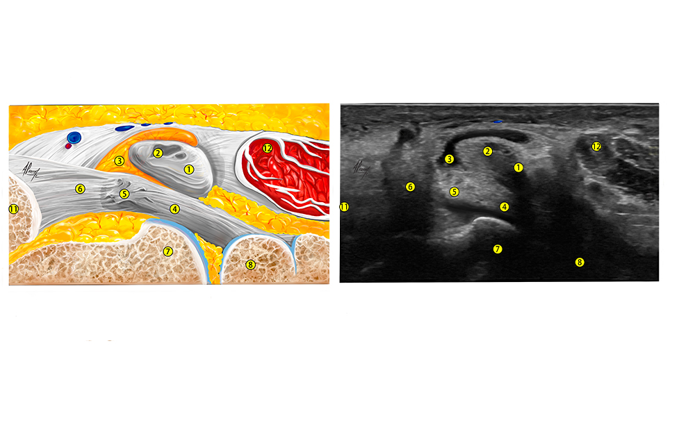 Imagen ecografica de la tenosinovitis tibial posterior