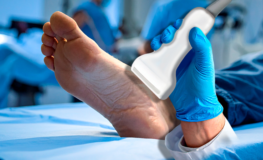Colocación de la sonda para el estudio del tendón tibial posterior.